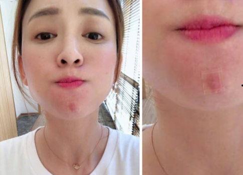 明星网红长痘,揭秘长痘背后的护肤真相